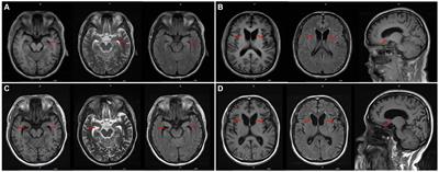 Case report: Misdiagnosed orolingual dyskinesia as a consequence of seizures in a chorea-acanthocytosis patient with a novel VPS13A variation from a family with consanguineous marriage